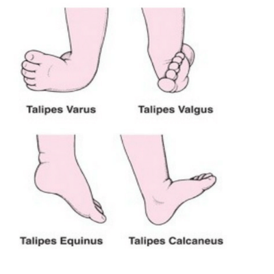 Clubfoot Types Clubfoot Types