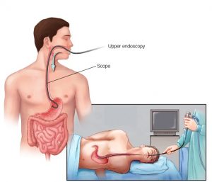 Upper Endoscopy